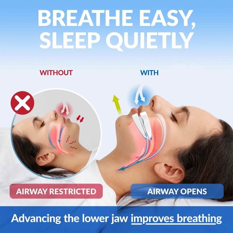 Adjustable Anti-Snoring Mouthpiece