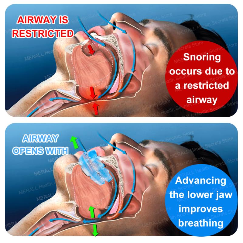 Anti Snoring Mouth Guard